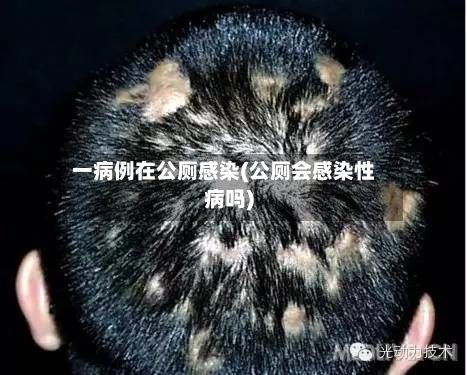 一病例在公厕感染(公厕会感染性病吗)-第2张图片