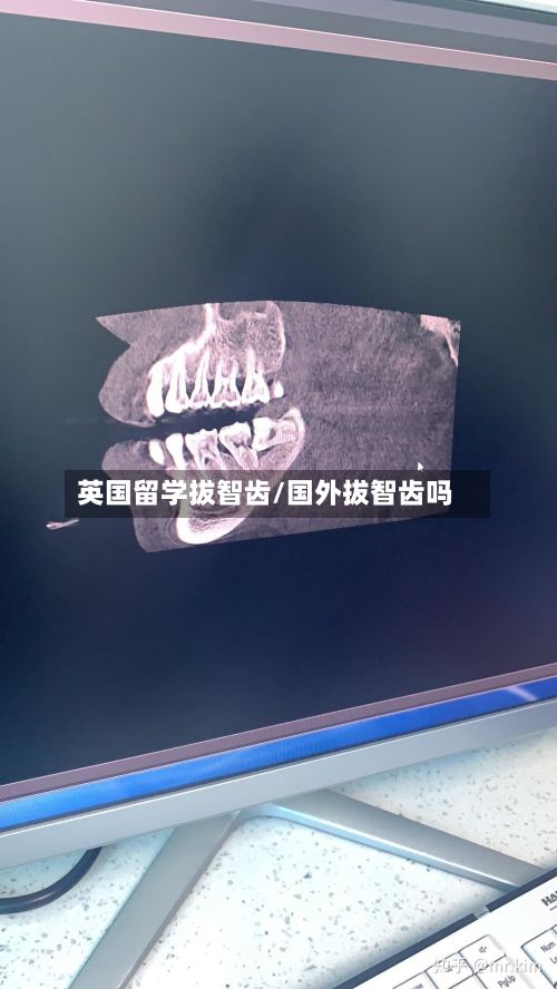 英国留学拔智齿/国外拔智齿吗