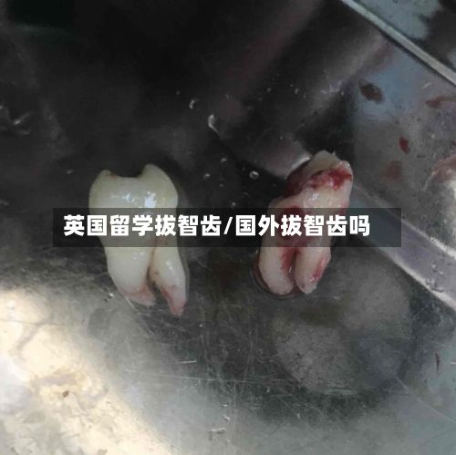 英国留学拔智齿/国外拔智齿吗-第2张图片